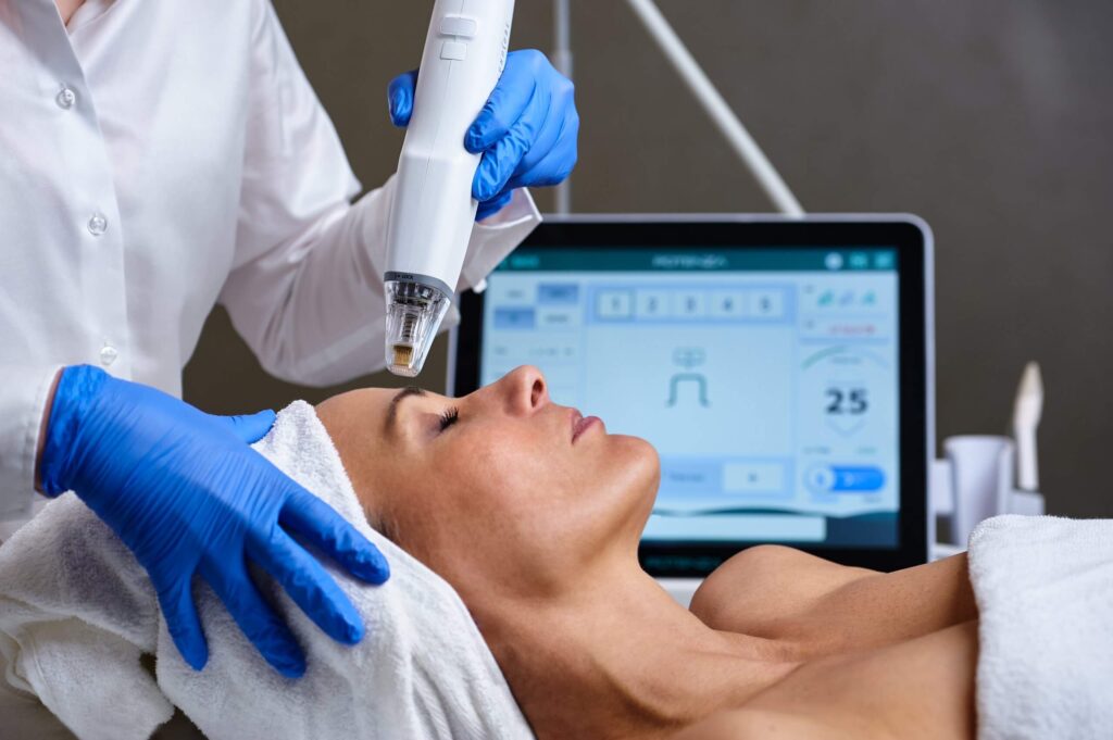 Radiofrequenz-Microneedling im Gesicht einer Patientin