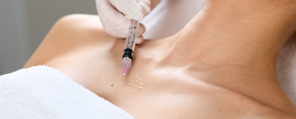 Mesotherapie am Dekollete