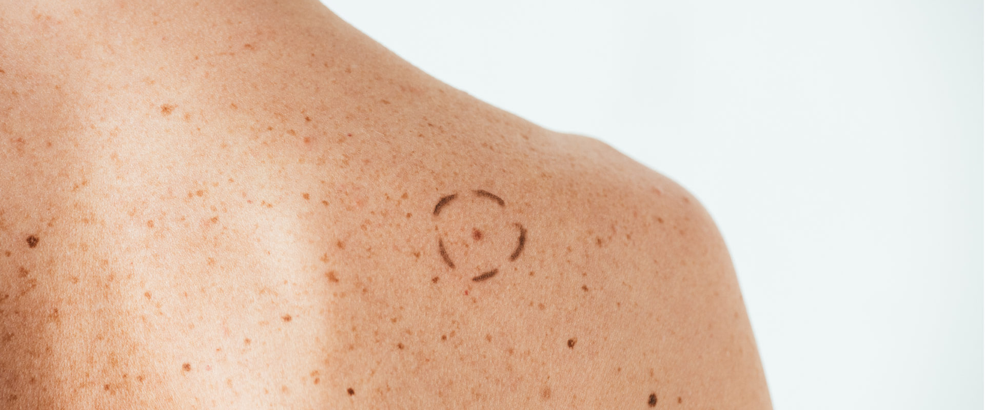 Muttermal-Untersuchung mit dem Dermatoskop