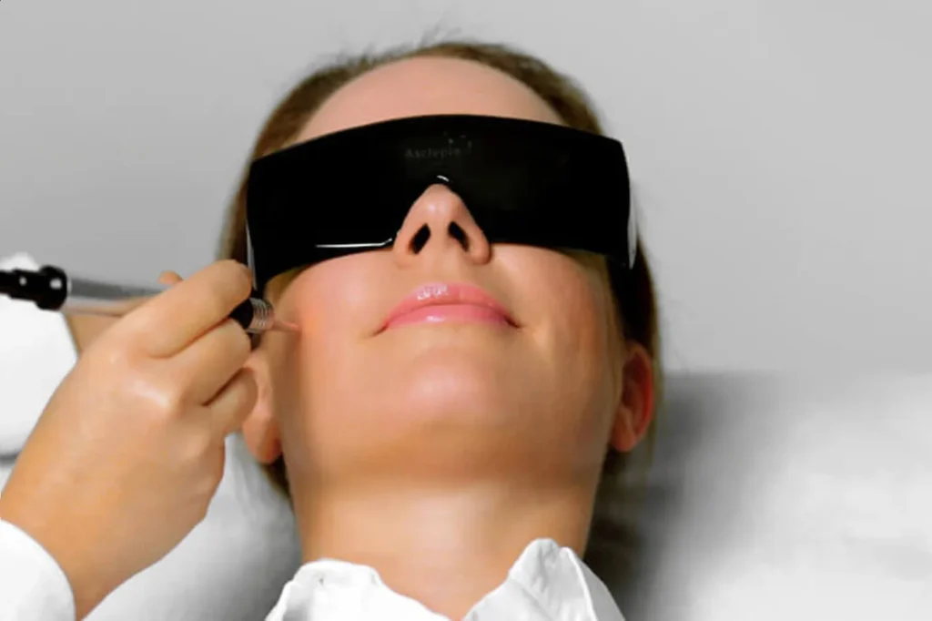 Laserbehandlung der Haut