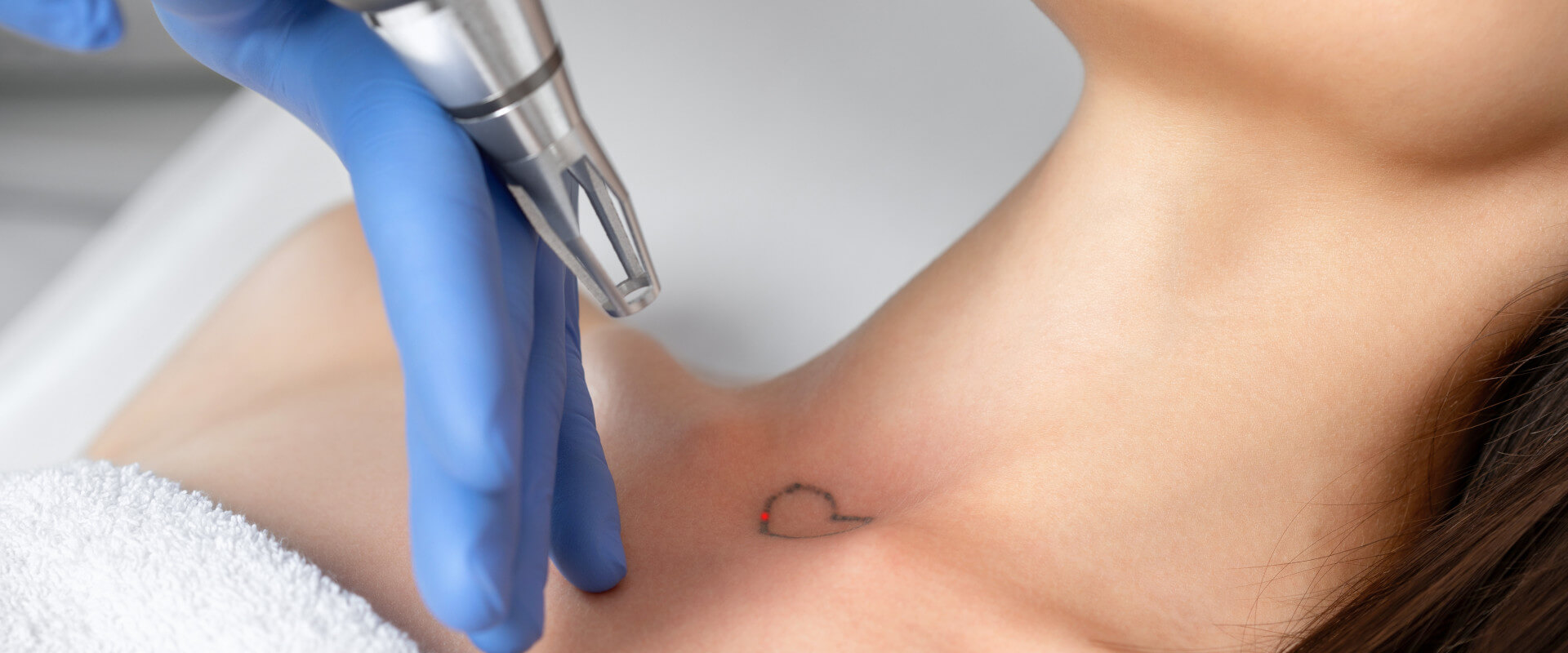 Laserbehandlung eines kleinen Tattoos am Schlüsselbein